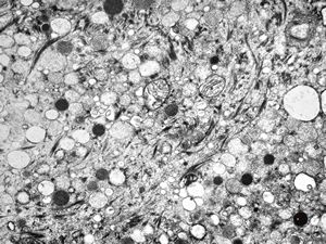 F, 59y. | pituitary adenoma (ACTH) … Crooke cell